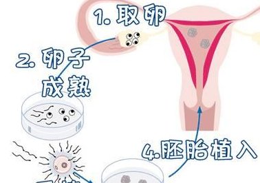 重度宫腔粘连在敦化市做试管婴儿靠谱吗，重度宫腔粘连试管婴儿成功率多少！